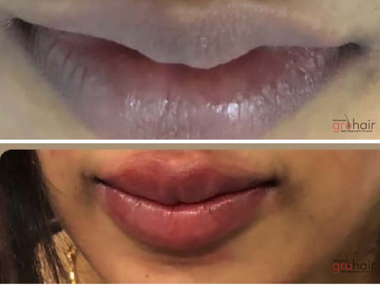 lip micropigmentation in omr