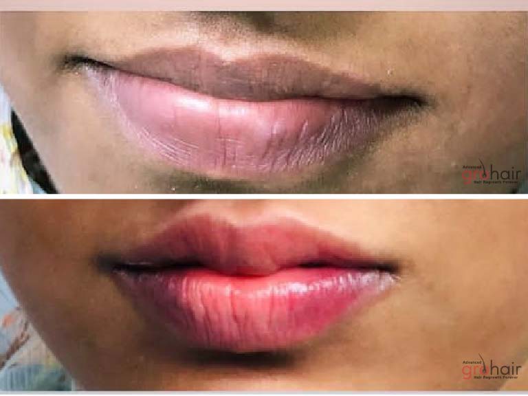 lip micropigmentation in chennai