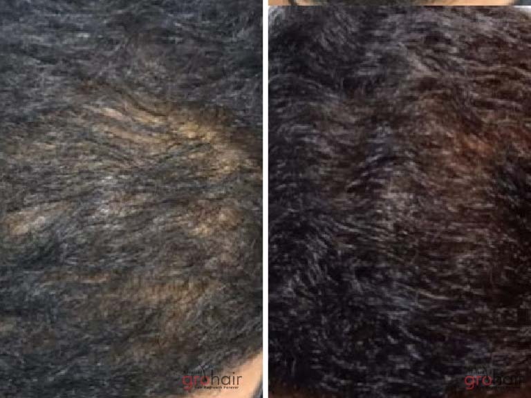 hair growth clinic in sholinganallur