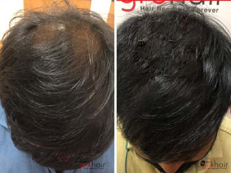 hair growth clinic in sholinganallur