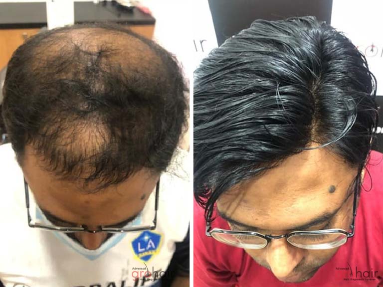 hair regrowth clinic in sholinganallur