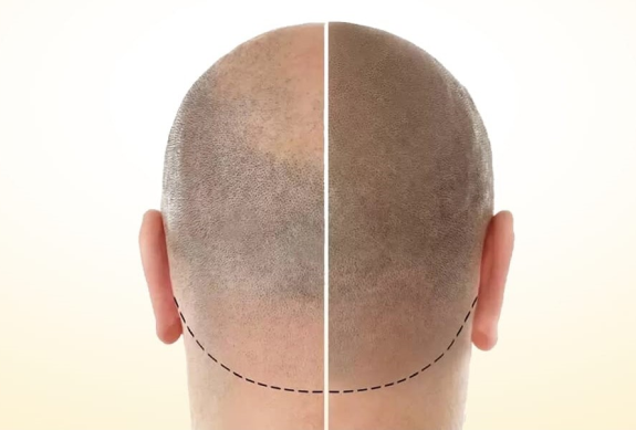 Scalp Micropigmentation